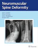 Cover of 'Neuromuscular Spine Deformity' 