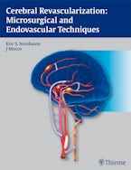 Cerebral Revascularization: Microsurgical and Endovascular Techniques