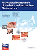 Microsurgical Management of Middle Ear and Petrous Bone Cholesteatoma